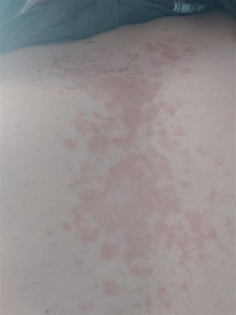 So Ive Had This Rash For Years It Comes And Goes Recently Went To The