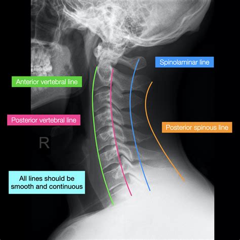 Anatomy Chart Lateral Cervical Spine Conditions Label