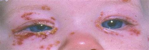 Eyelid Dermatitis Xeroderma Of The Eyelids Eczema Of The Eyelids