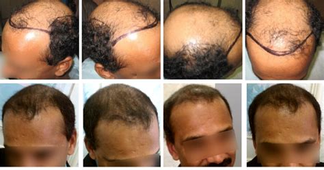 How Accelerated Follicular Restoration Afr Reduces The Length Of
