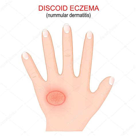 Nummular Dermatitis Discoid Eczema Is A Chronic Skin Condition That