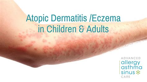 Atopic Dermatitiseczema In Children And Adults