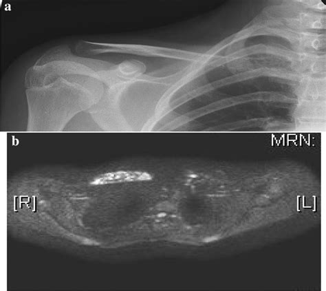 A Plain Radiograph Of The Right Clavicle In A Patient With Painful