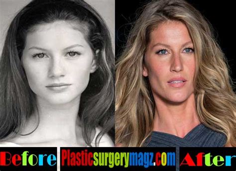 Gisele Bundchen Plastic Surgery Before And After Plastic Surgery Magazine