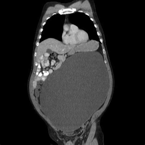 An Unusual Cause Of Gross Abdominal Distension In A 59 Year Old Man