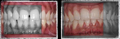 Overcrowding if your teeth are only slightly crooked due to minor overcrowding, you may be able to get your teeth aligned using a retainer. Gaps between teeth? - Fort Dental Clinic