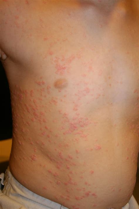 Skin Disease Types Guttate Psoriasis