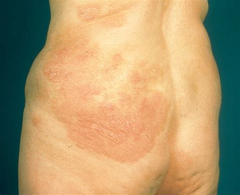 Cutaneous T Cell Lymphoma Mycosis Fungoides Diseases And Conditions