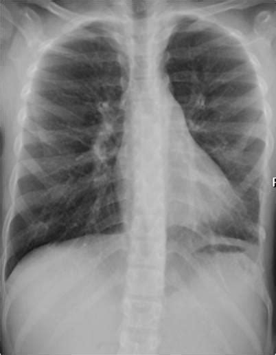 Osteosarcoma Of The Rib Eurorad