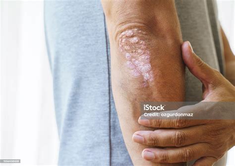 Man With Psoriasis On His Elbows Stock Stock Photo Download Image Now