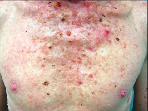 Actinic Keratosis Concise Medical Knowledge Hot Sex Picture