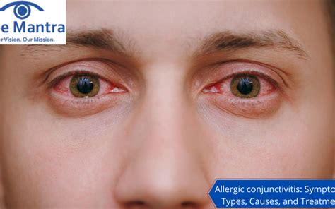 Allergic Conjunctivitis Symptoms Types Causes And Treatment