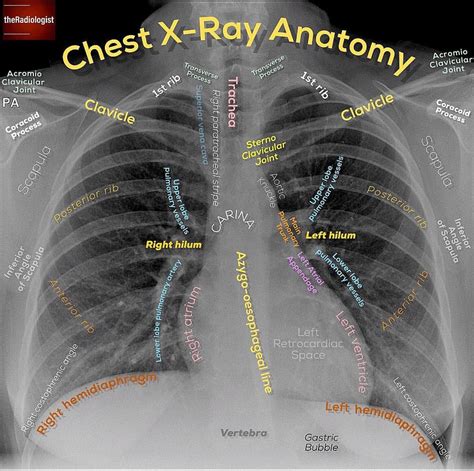 Anatomy Of Chest X Ray Cxr Anatomy Radiology Student Medical