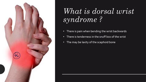 Dorsal Wrist Syndrome Everything You Wanted To Know Youtube