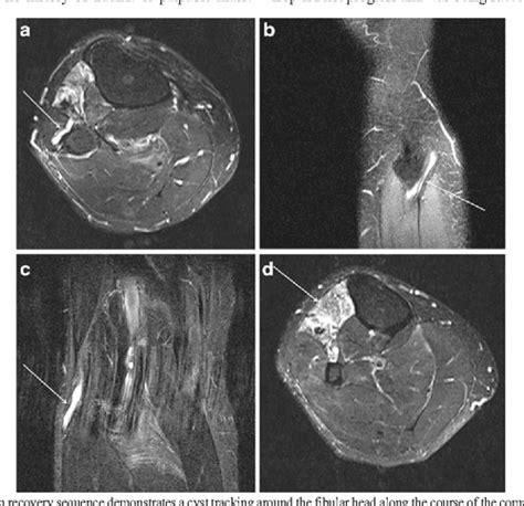 Ultrasound Guided Aspiration And Injection Of An Intraneural Ganglion