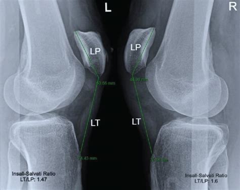 Lateral Knee Radiographs After Bilateral Patellar Tendon Rupture