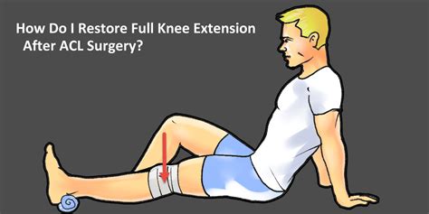 Full Knee Extension After ACL Surgery Exercises To Help You Straighten Your Knee ACL