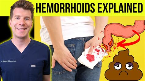 Doctor Explains Hemorrhoids Aka Piles Causes Symptoms Treatment