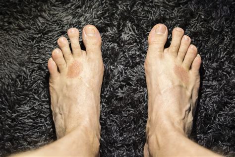 5 Types Of Foot Rash What Causes Them And How To Treat Them
