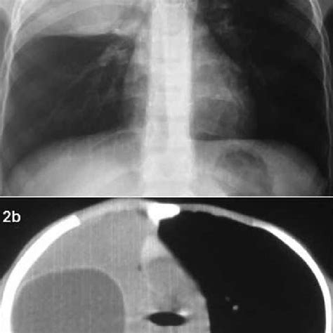 The Appearance Of Multiple Hydatid Cysts Located In The Left Lower Lobe