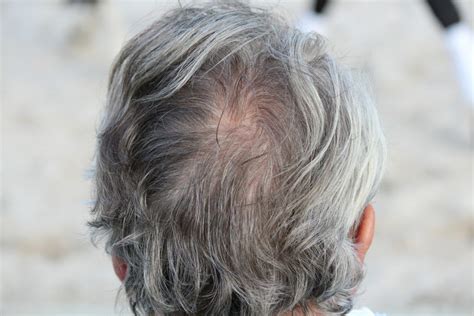 Premature Hair Greying Surprising Reasons You May Not Know