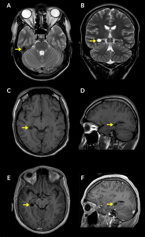 Brain Magnetic Resonance Imaging Mri Scan In A Patient With Dnet