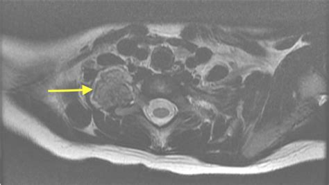 Cureus Horner Syndrome Secondary To Osteochondroma Of The First Rib