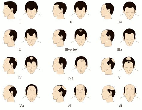 Korea Hair Transplant Center Hair Loss In Men And Treatment Methods
