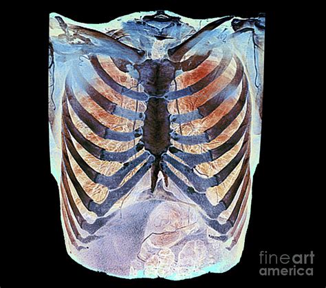 Healthy Rib Cage Photograph By Zephyrscience Photo Library Pixels