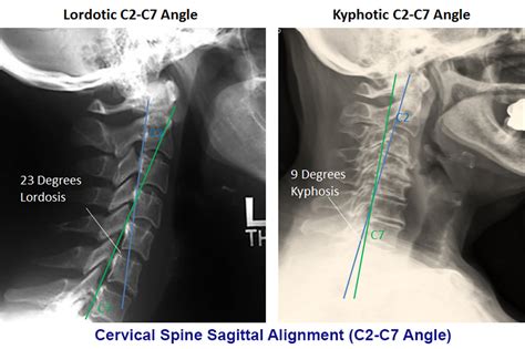 Cervical Myelopathy Spine Orthobullets