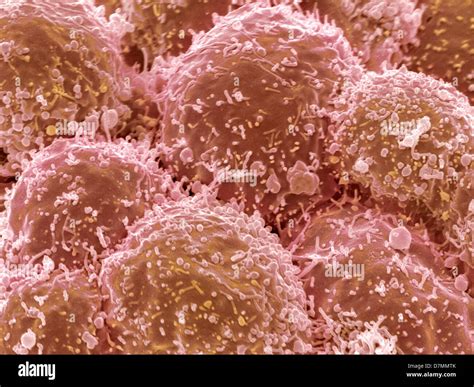 Lung Cancer Cells Sem Stock Photo Alamy