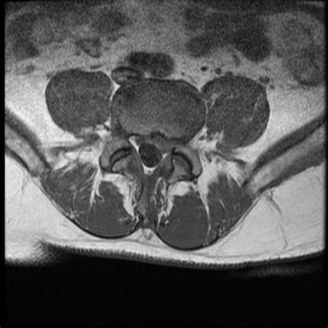 Disc Protrusion Compressing L5 Nerve Root Image