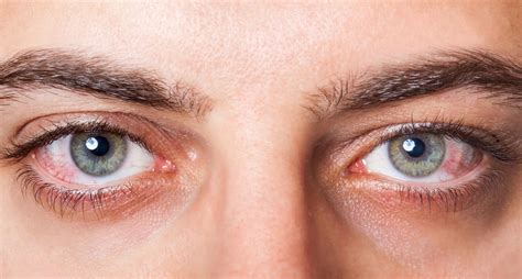 What Is Blephex Dry Eye Treatment Kugler Vision