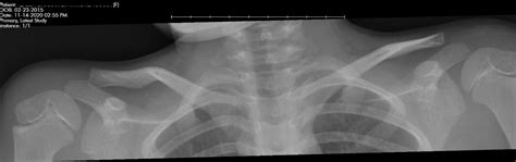 Old Healed Fracture Of Right Scapula And Clavicle