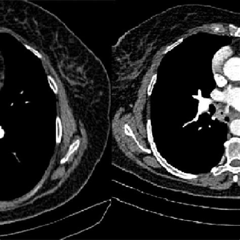 Left Image Axial Cect Shows The Cardiac Bronchus Curved White Arrow