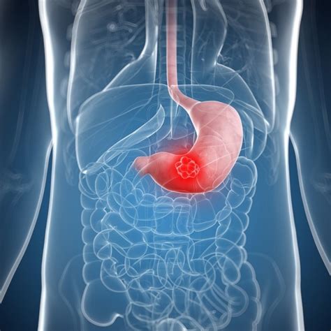 Early signs of stomach cancer may include: Stomach cancer: Causes, symptoms, treatments and more ...