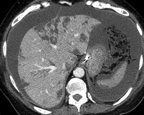 Liver Atlas Diagnosis Hepatocellular Necrosis