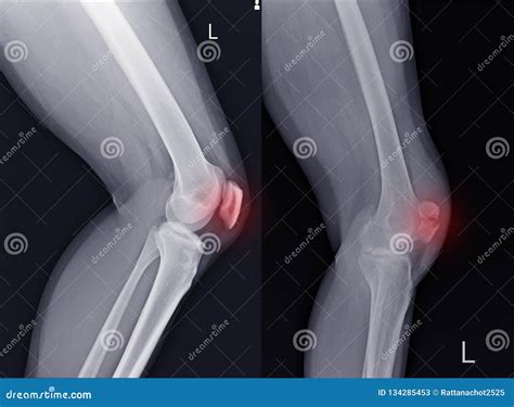 X Ray Left Knee Lateral Showing Kneecap Fracture And Post Operation