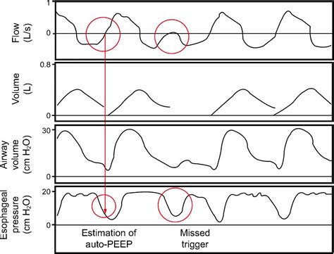 Ventilator Graphics Scalars Loops And Secondary Measures Respiratory