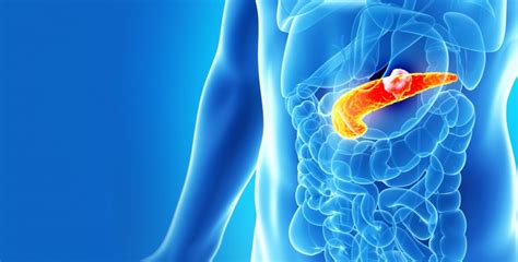 Pancreatic cancer symptoms and signs often do not manifest until the cancer has metastasized. Pancreatic Cancer | Lehigh Valley Health Network
