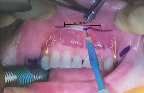 Location Of The Intraoral Vestibular Incision For Tot A 1020 Mm