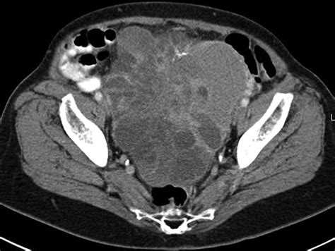 Incidental Adnexal Masses Detected At Low Dose Unenhanced CT In