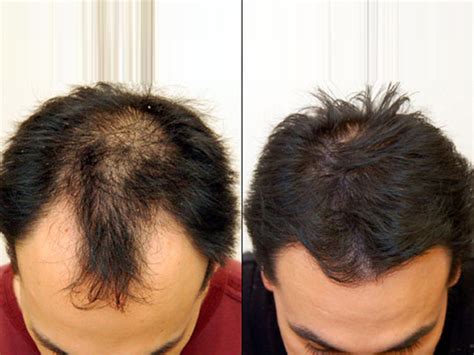 Fut Or Fue Hair Transplant Which One Is Right For You Hair Transplant Abroad