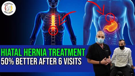 Hiatal Hernia Treatment 50 Better After 6 Visits Youtube