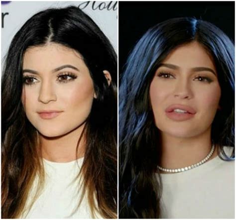 Kylie Jenners Lips Before And After Pictures Of Her Pout