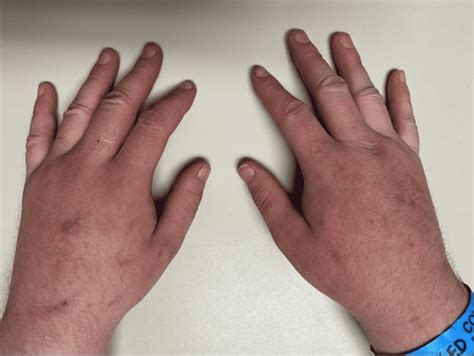 15 Causes And Triggers Of Hand Swelling You Shouldnt Ignore List