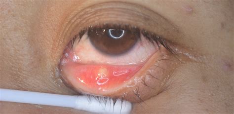 Yellow Or White Eye Bump Symptoms Causes And Common Questions Buoy