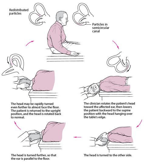 Benign Paroxysmal Positional Vertigo Ear Nose And Throat Disorders