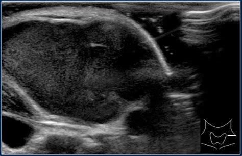 The Radiology Assistant Neck Masses In Children