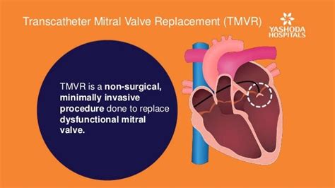 Transcatheter Mitral Valve Replacement Tmvr